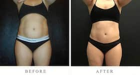 Try cool sculpting to get rid of unwanted fat without surgery
