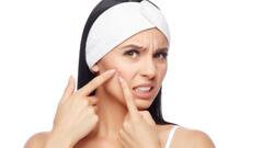 DIY face mask to get rid of pimples