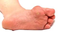 Corn and calluses: foot care tips for diabetics