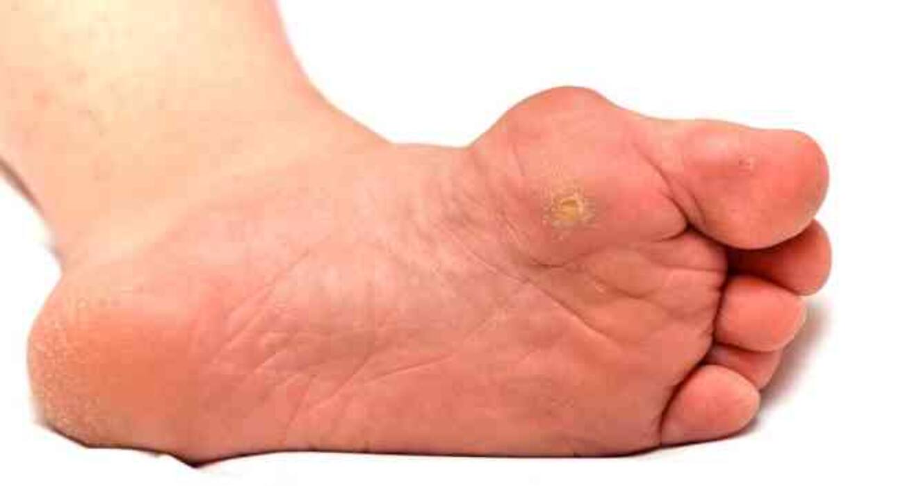 Corn and calluses: foot care tips for diabetics