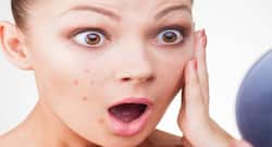 Does squeezing or popping pimples worsen acne?