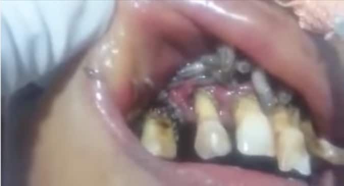 Oral Myiasis: This video of squirming maggots in this woman's mouth is