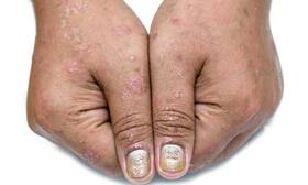 Is your homeopath addressing your psoriasis correctly?