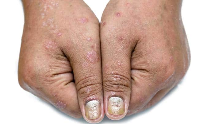 6 things you must know about psoriasis | TheHealthSite.com