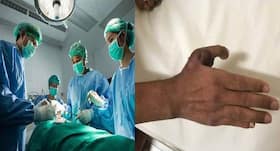 Navi Mumbai doctor successfully replaces 35-year-old’s lost thumb by grafting the toe