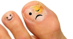 Real people tell you what helped them to get rid of toenail fungus