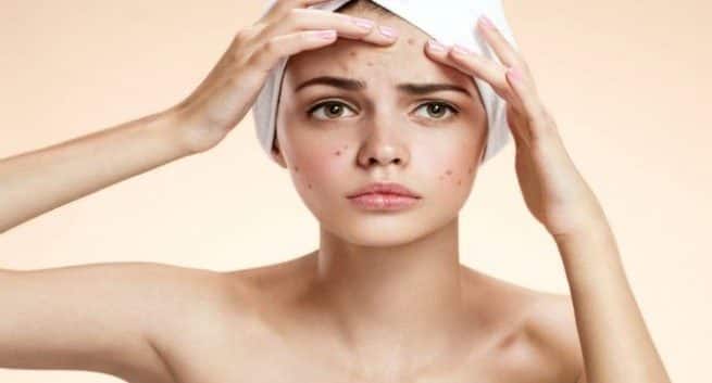 7 facts about adult acne that you should know | TheHealthSite.com