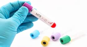 World AIDS Day 2017: Why HIV patients are at risk of TB co-infection