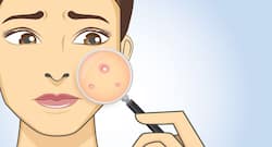 Tricks to get rid of hard pimples