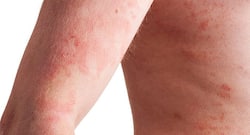 Psoriasis से जुड़ी ये 5 हैरान करने वाले बातें हर किसी को जाननी चाहिए