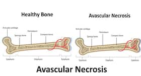 What is Avascular Necrosis (AVN)?