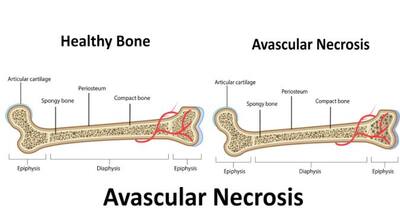 What is Avascular Necrosis (AVN)? | TheHealthSite.com
