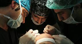 8 myths and facts on hair transplant busted by an expert
