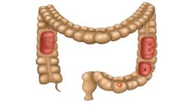 Am I at risk of colorectal cancer if anyone in my family has it? (Query) Am I at risk of colorectal cancer if anyone in my family has it? (Query)