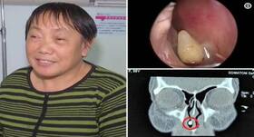 Supernumerary teeth: The condition in which a tooth grows in any part of the face!