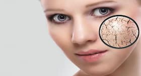 सर्दियों में चेहरे पर क्यों दिखते हैं ड्राई पैच?