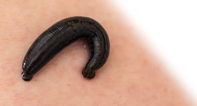 How to remove a leech -- tips to follow