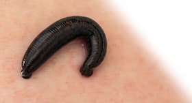 How to remove a leech -- tips to follow
