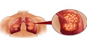 How air pollution is making Indians susceptible to lung cancer