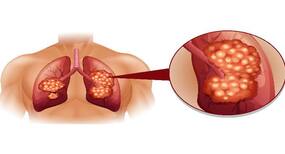 Case studies: Lung cancer among non-smokers is in rising and how surgical intervention can help to treat it