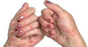 How Ayurveda and yoga for psoriasis can help