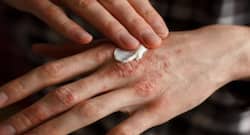 Probiotics for psoriasis: Does it really help?