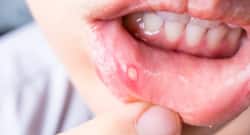 Treat canker sores with these home remedies