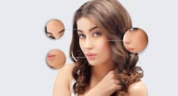 Guava leaves, mint leaves, methi leaves and more home remedies for acne