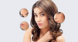 Guava leaves, mint leaves, methi leaves and more home remedies for acne