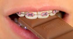 क्या आपके बच्चे को dental braces लगे हैं? इन डायट टिप्स को फॉलो करें