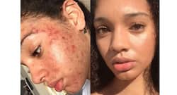 This Instagrammer healed her acne using natural ingredients!