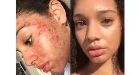 This Instagrammer healed her acne using natural ingredients!
