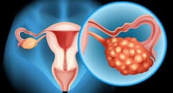 Lack of awareness delays diagnosis of ovarian cancer, says study