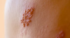 Can tulsi or holy basil be used for treating herpes naturally?