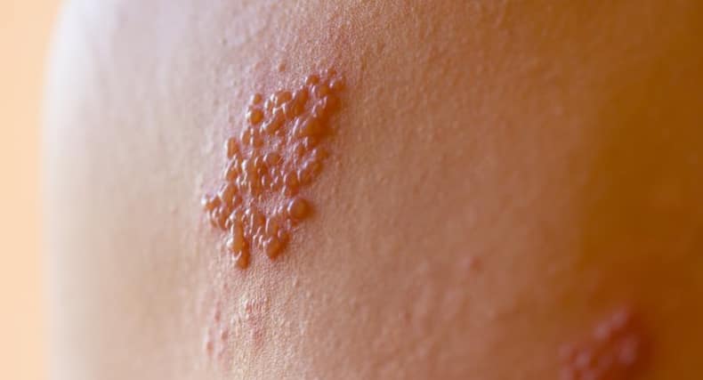 herpes