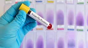 Bird flu or Avian Flu: 5 important facts you must know about