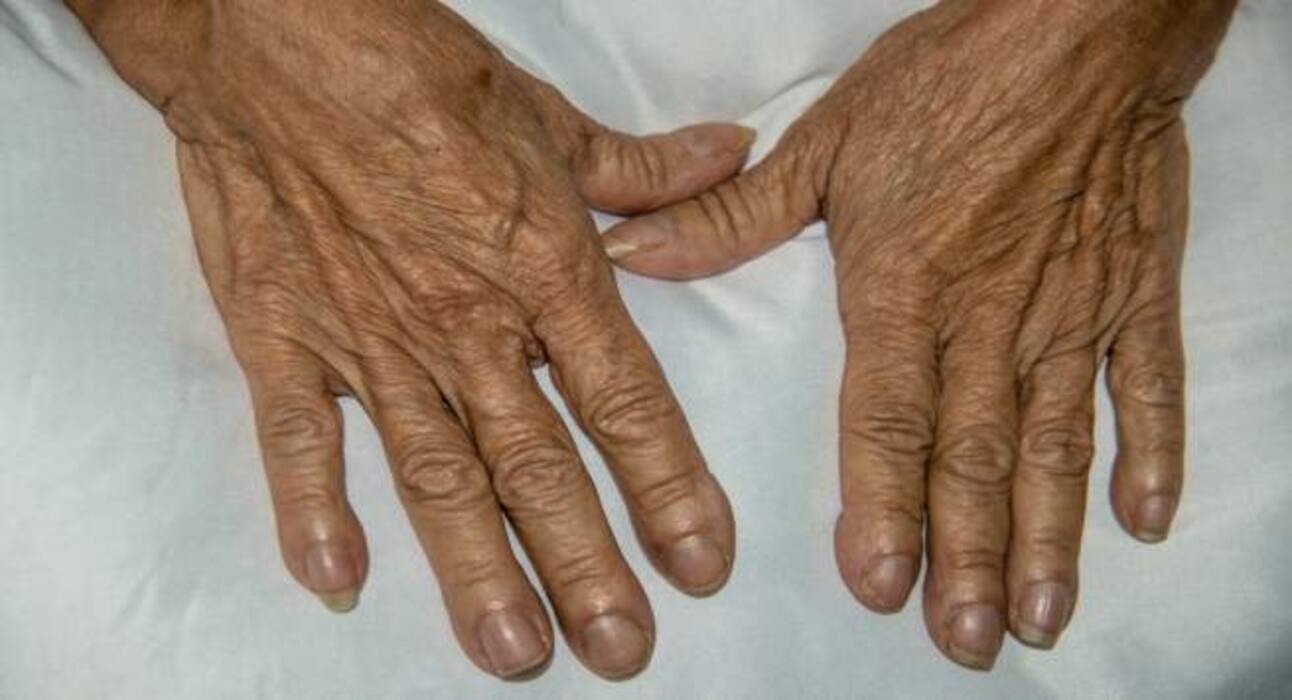 5 unusual signs of lung cancer you must be aware of!