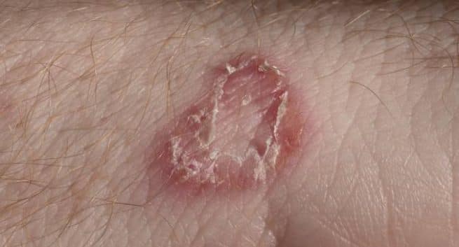 Fungal Infections Of The Skin Pictures Images The Meta Pictures