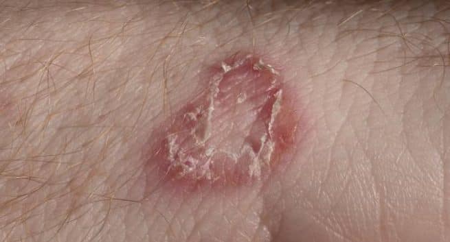 Fungal Infections Of The Skin Pictures Images - the meta pictures