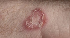 Dos and don'ts to treat fungal skin infections
