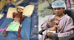 A severely premature baby girl child undergoes rare pediatric cardiac surgery; life saved by Artemis Hospital