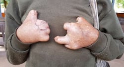 Need more awareness on leprosy in country: Vice President