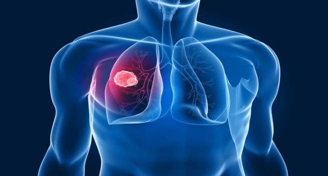 Lung cancer can be spotted by an early blood test | TheHealthSite.com