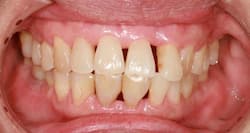 Bad oral hygiene can cause lung, colon cancers