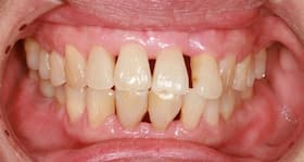 Bad oral hygiene can cause lung, colon cancers