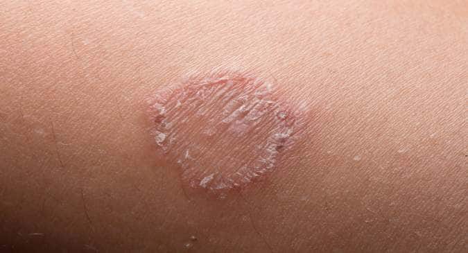 5 common myths about ringworm infections busted! - Read 