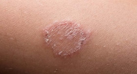 Ringworm Home Remedies: बारिश के मौसम में होने वाली खाज-खुजली से राहत दिलाता है ये एक नुस्खा, त्वचा पर नहीं रहते दाद के निशान