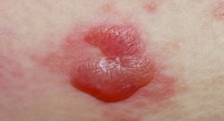 Pemphigoid: expert derma explains the causes, symptoms and treatment options