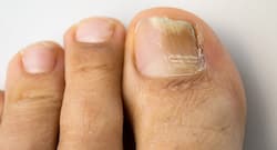 Everything you need to know about fungal nail infections