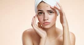 Say bye to acne and acne scars with few cloves of garlic